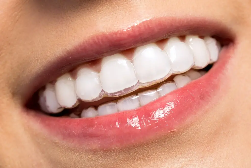 What is the difference between at-home clear aligners and regular braces?